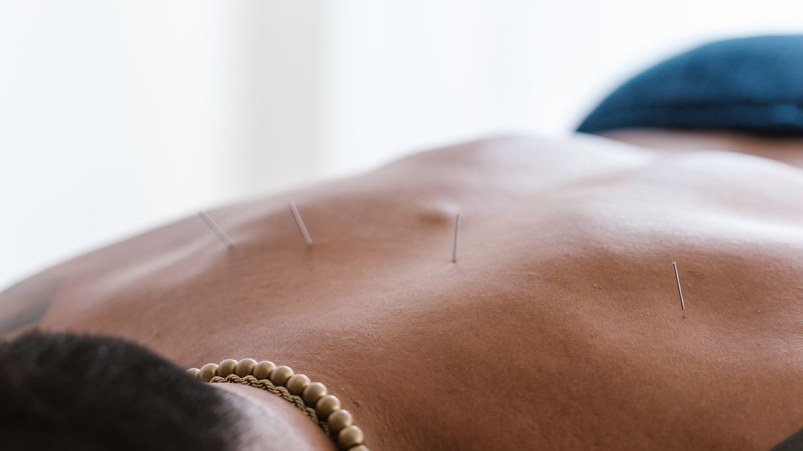 Confira artigo sobre a Técnica de Dry Needling