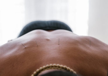 Dry Needling ou Agulhamento a Seco alivia a dor muscular e mais