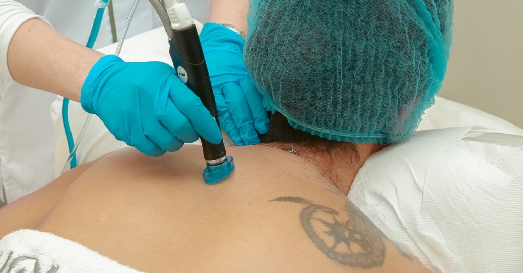 radiofrequência pulsada: os anos passam e continuam com as mesmas incógnitas