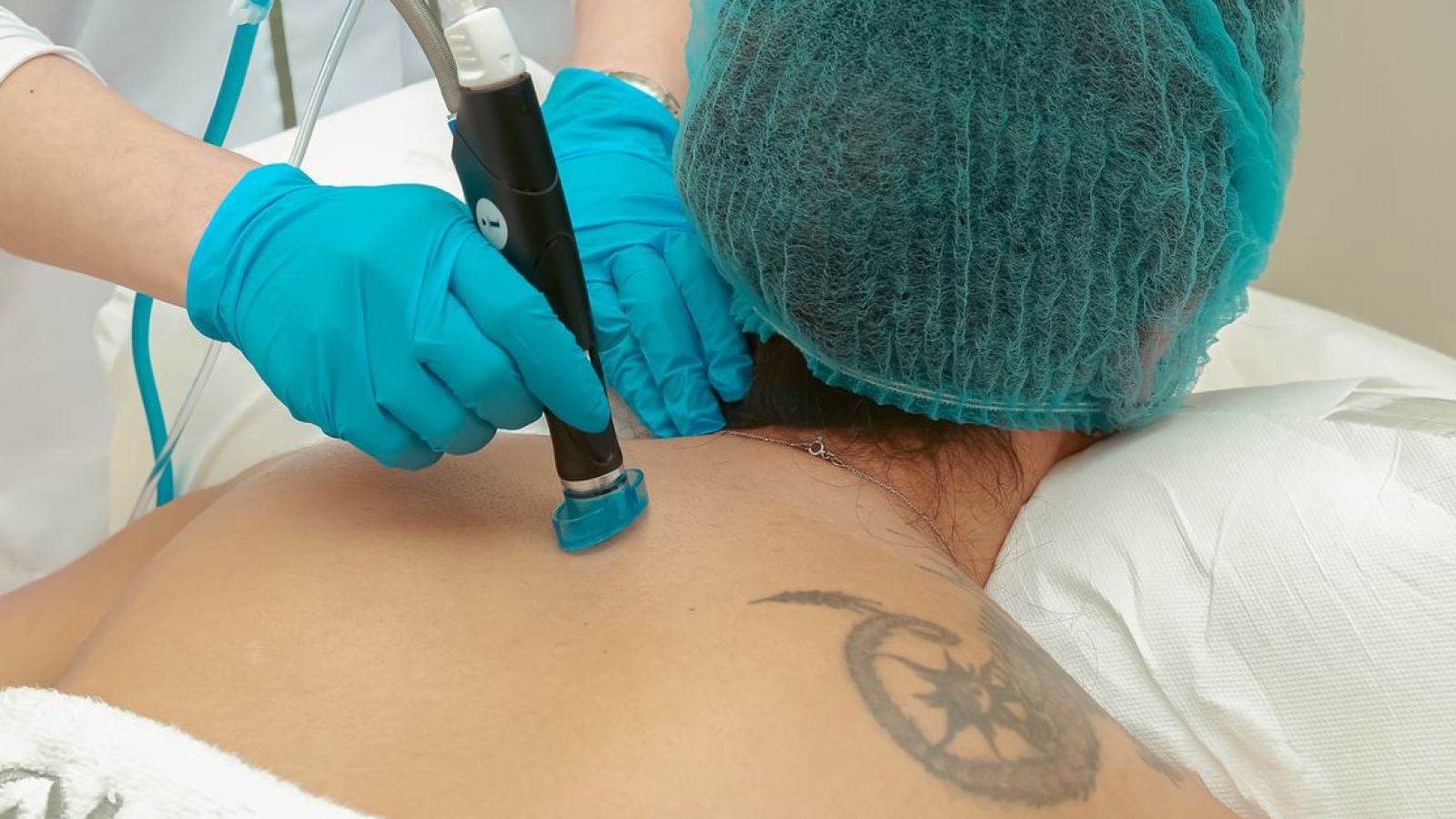 radiofrequência pulsada: os anos passam e continuam com as mesmas incógnitas