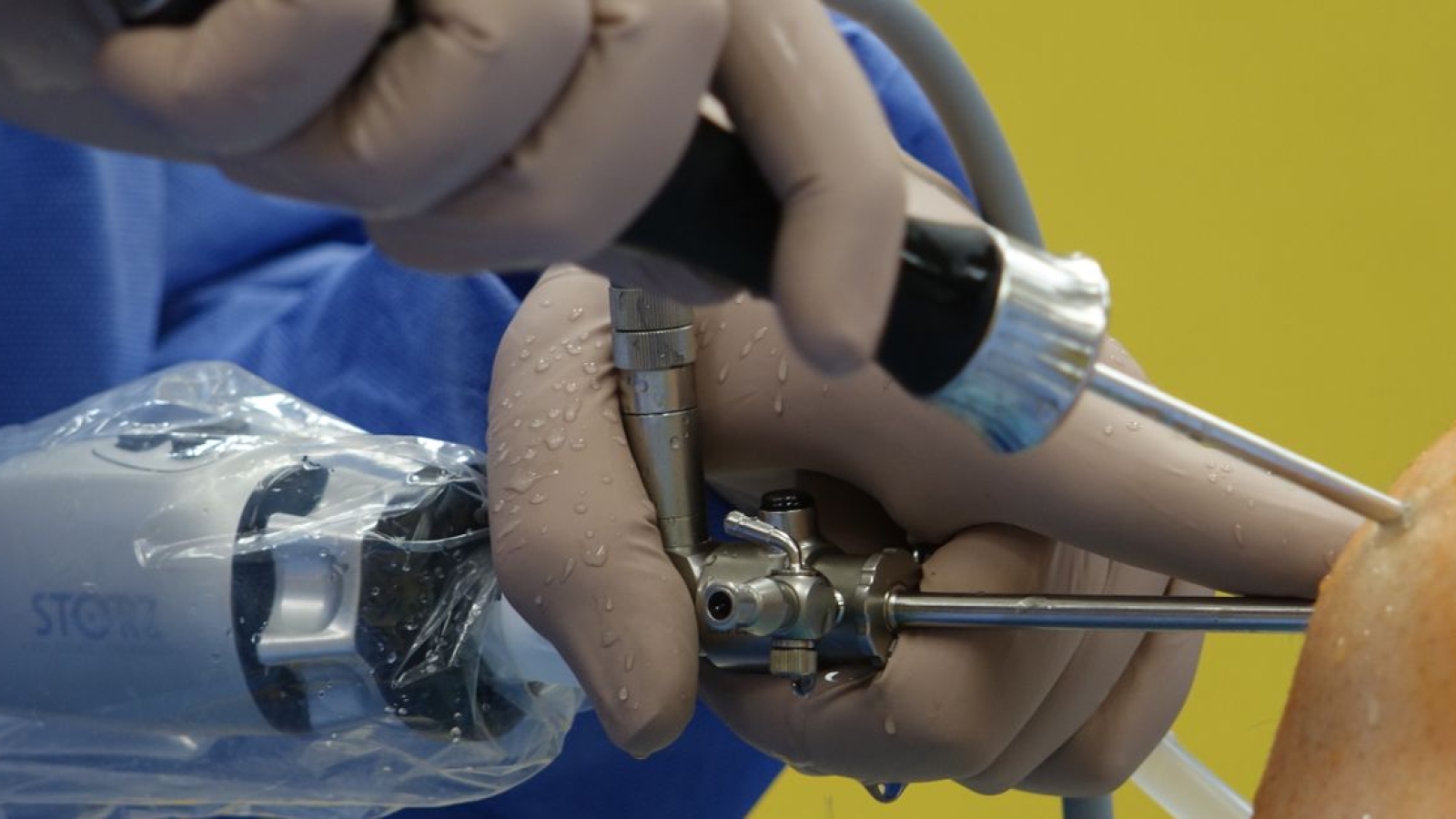 Reconstrução do Ligamento Cruzado Anterior (LCA) Ir para: navegação, pesquisa