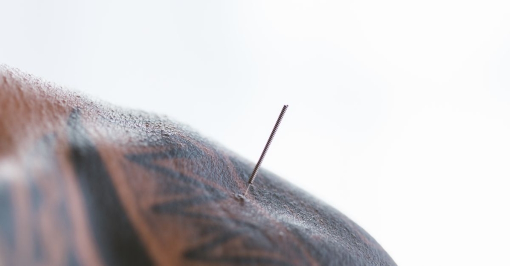 Artigo Completo sobre Dry Needling – Agulhamento Seco