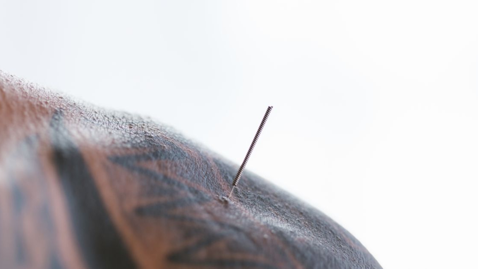 Artigo Completo sobre Dry Needling – Agulhamento Seco