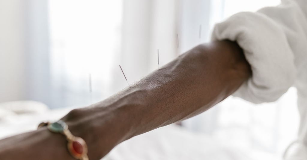 Artigo Sobre Agulhamento Seco – Dry Needling