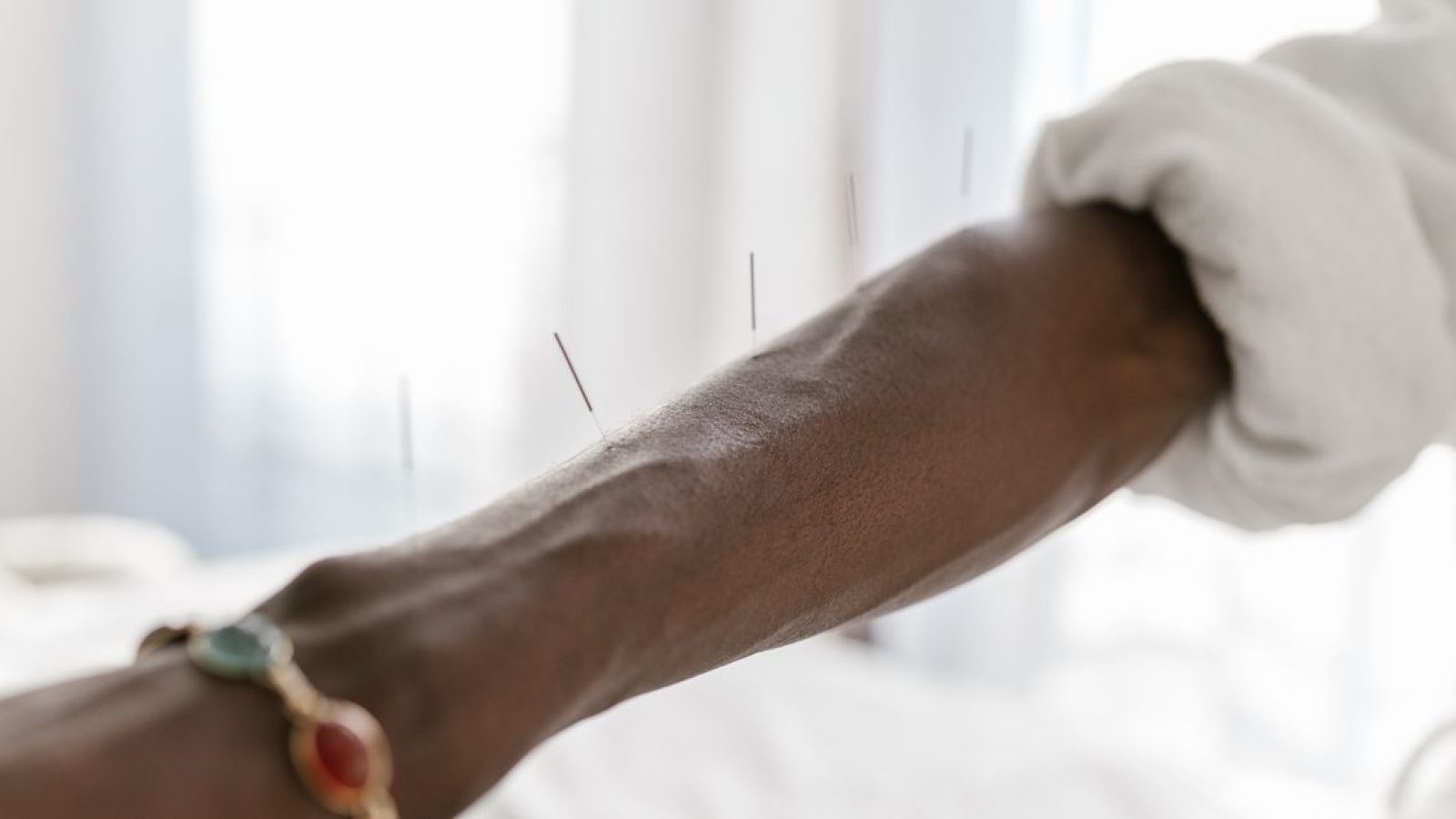 Artigo Sobre Agulhamento Seco – Dry Needling