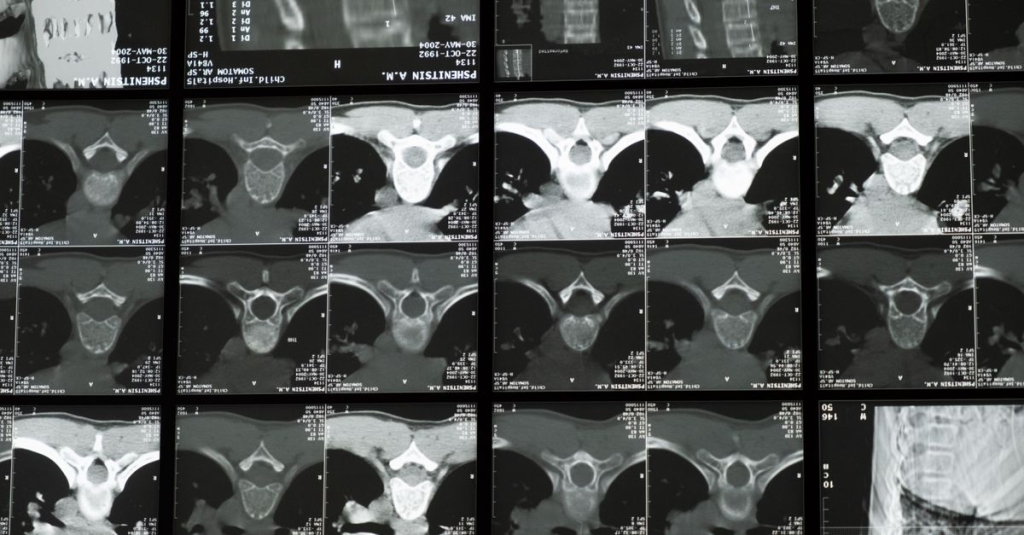 Discectomia cervical anterior e fusão