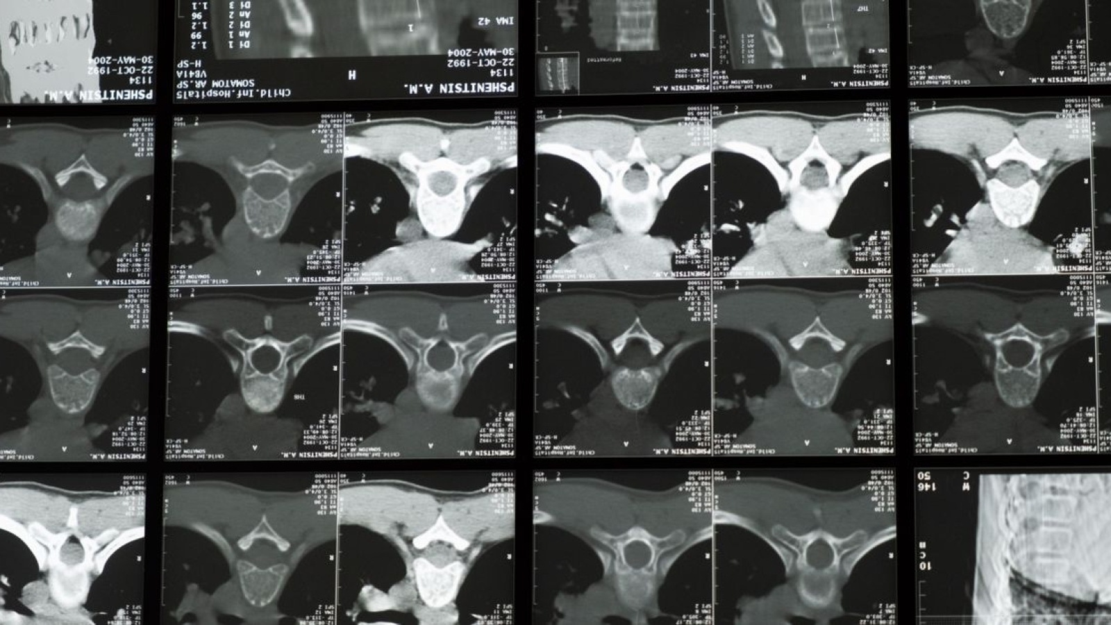 Discectomia cervical anterior e fusão
