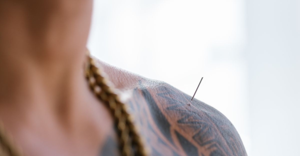 Dry Needling: A Técnica de Agulhamento Seco na Fisioterapia
