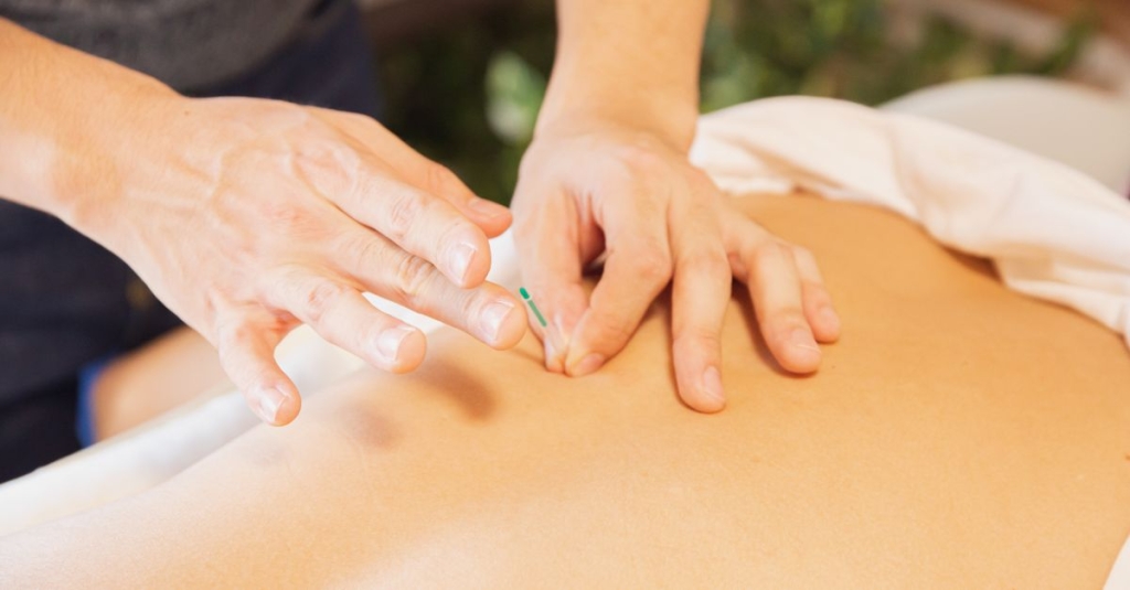 Dry Needling ou Agulhamento Seco – O que você precisa saber