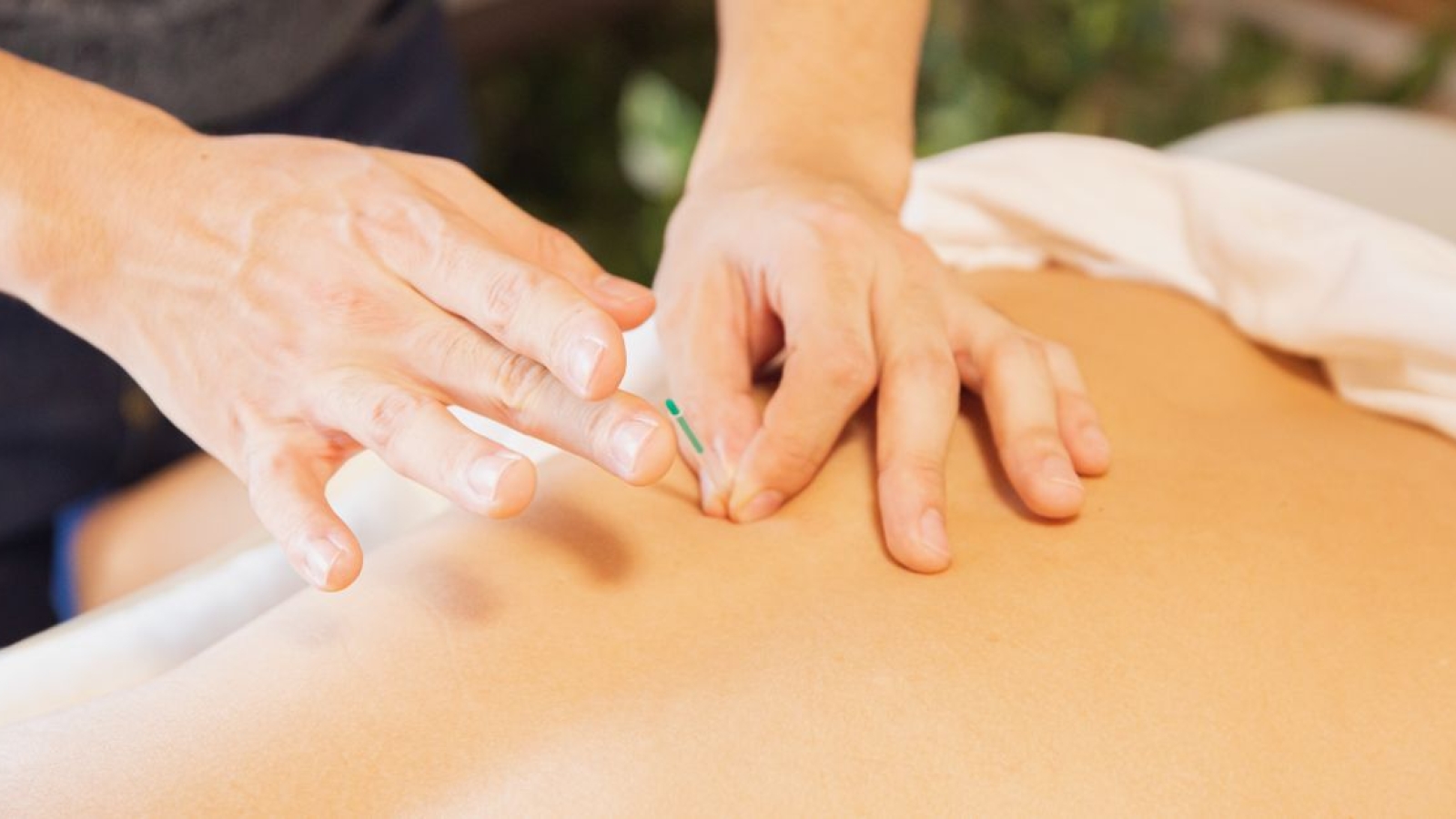 Dry Needling ou Agulhamento Seco – O que você precisa saber