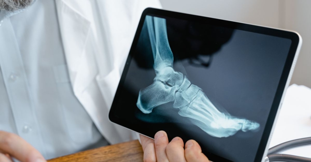 Lesão do Ligamento Lateral do Tornozelo