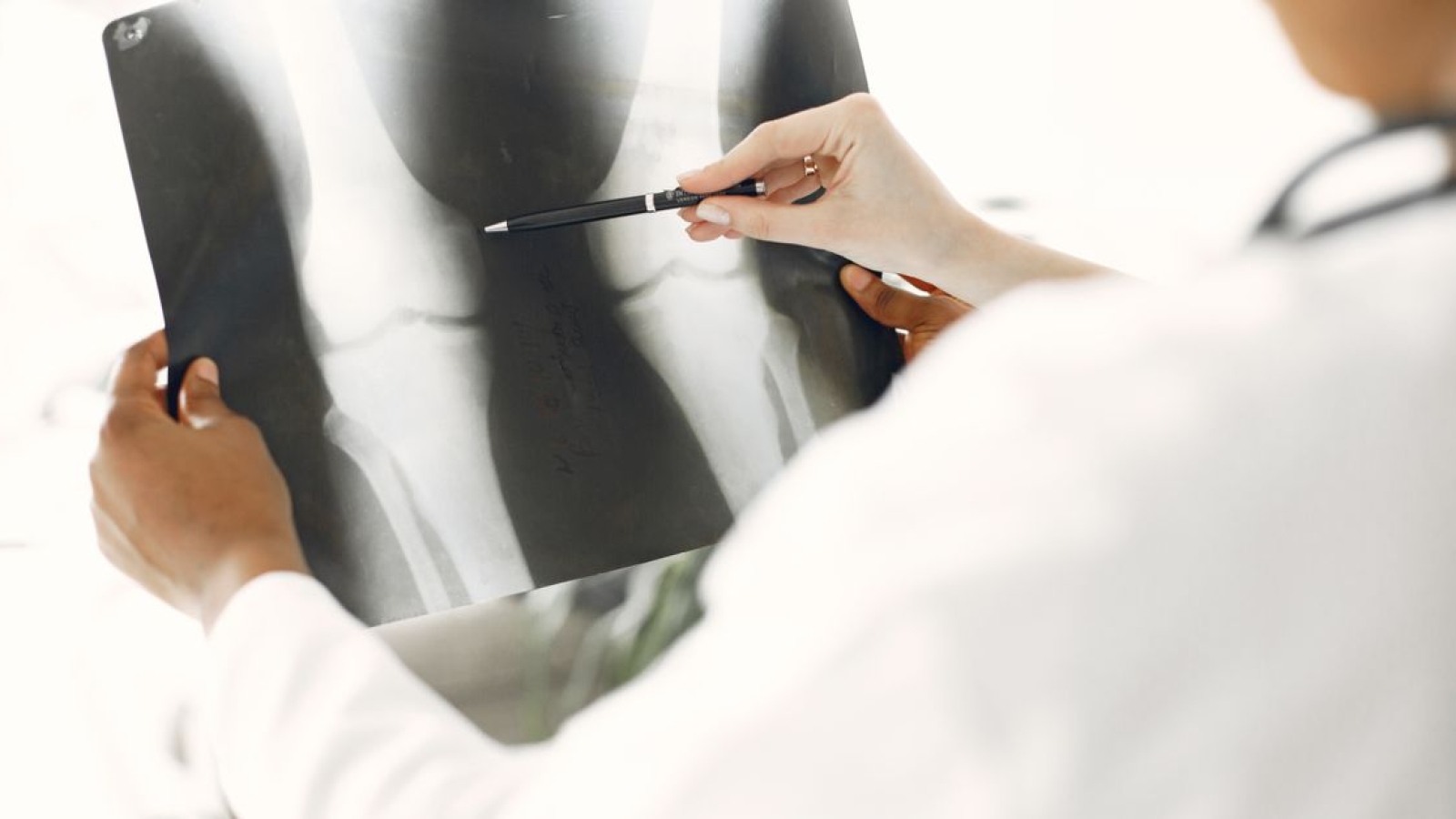Menisco Lateral: Anatomia, Vascularização e Lesões