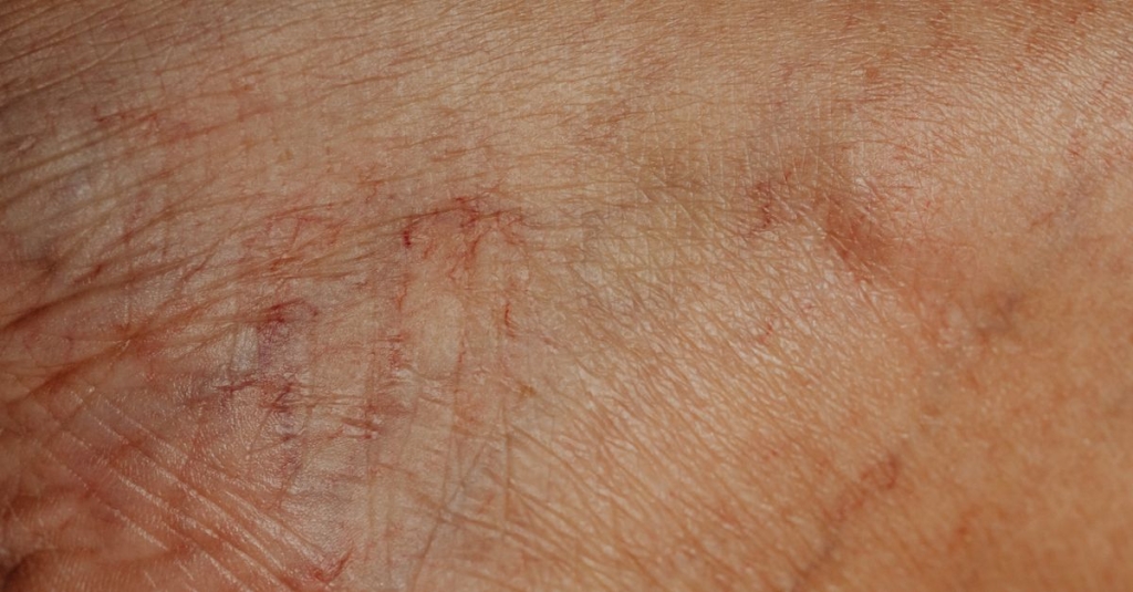 Necrose avascular da cabeça femoral