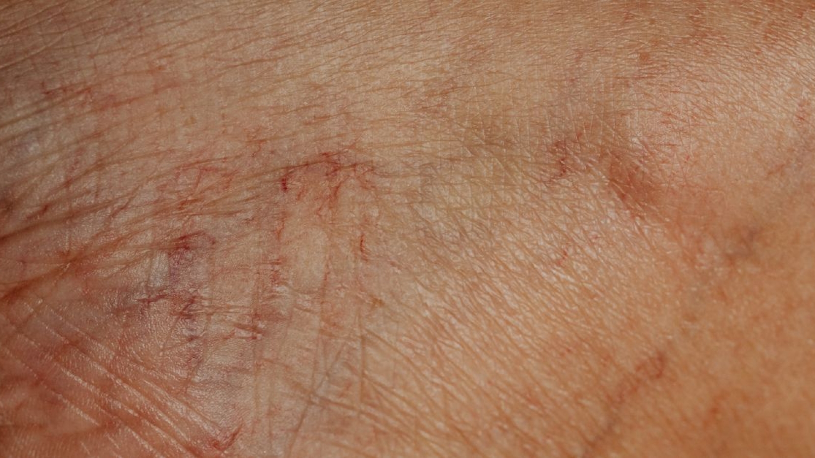 Necrose avascular da cabeça femoral