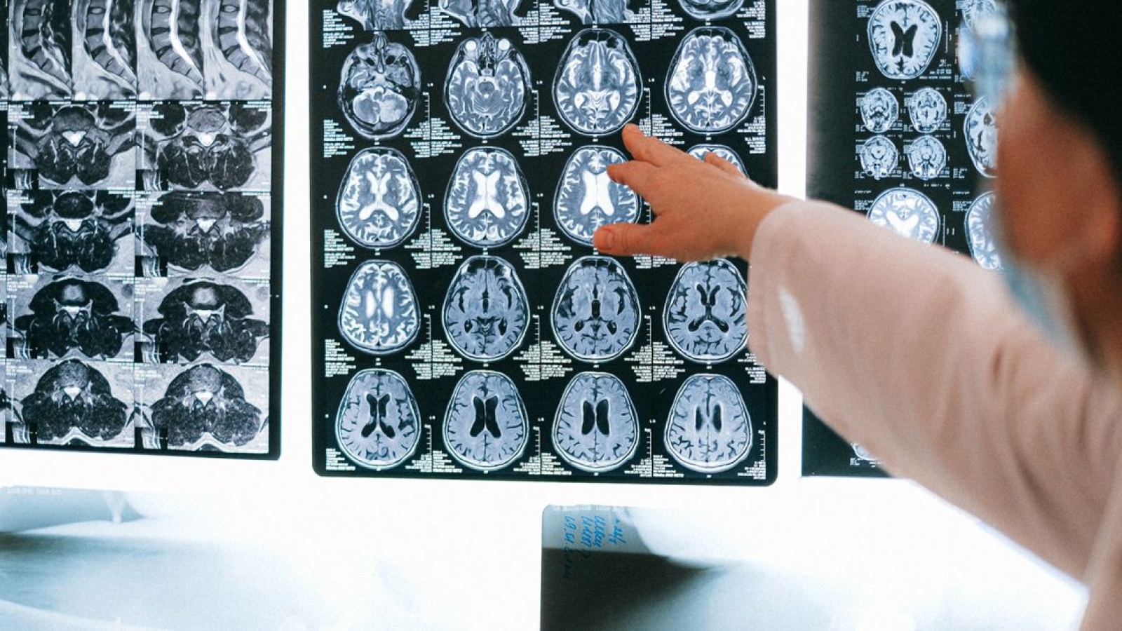 Padrões Internacionais para Classificação Neurológica da Lesão Medular (ISNCSCI)