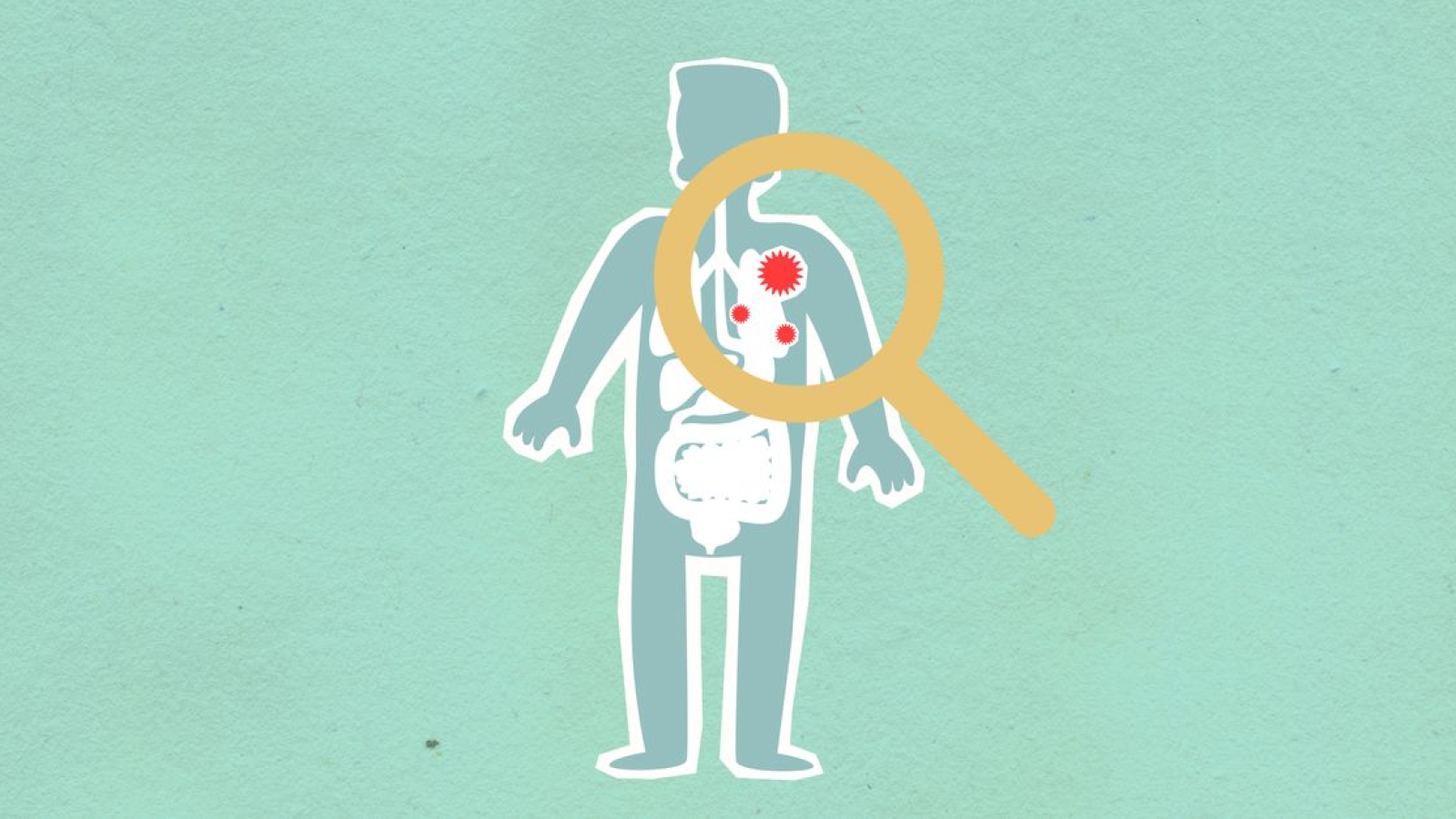 Polineuropatia por Doença Crítica (CIP)