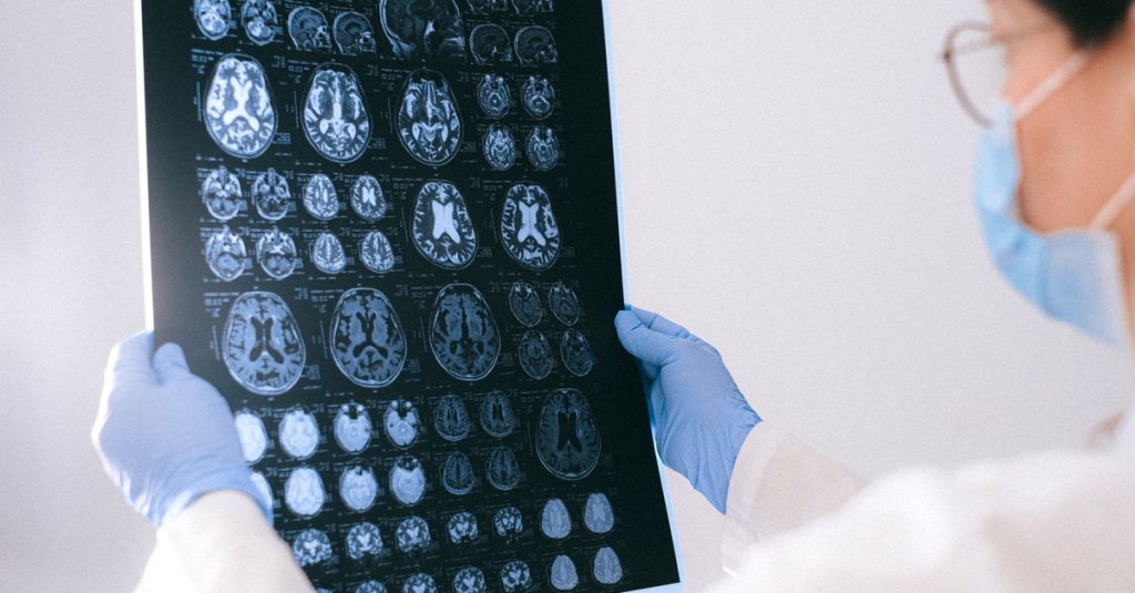 Síndrome do Tremor / Ataxia X Frágil