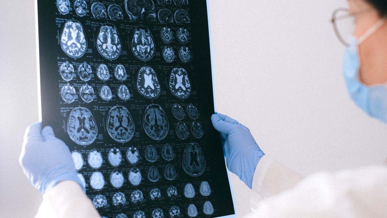 Síndrome do Tremor / Ataxia X Frágil